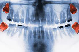 radiograph of wisdom teeth